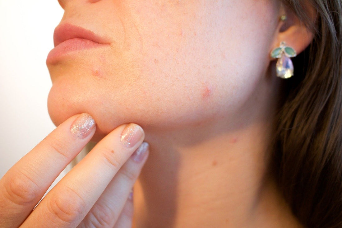Fight Acne With These 8 Ingredients