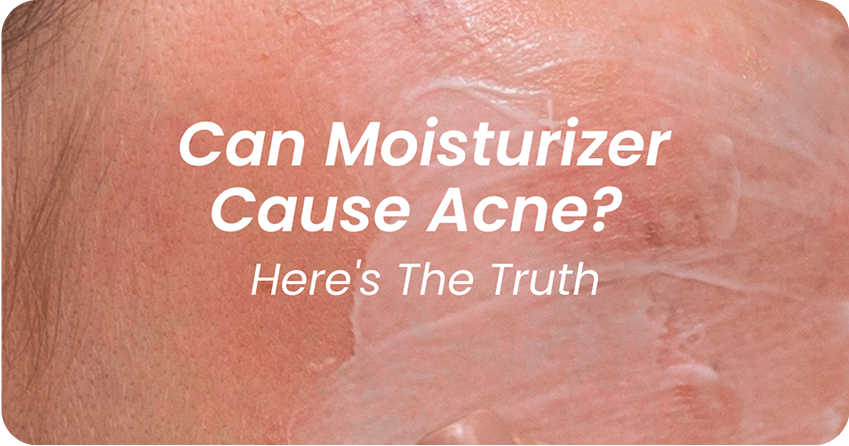 Can Moisturizer Cause Acne? The Truth About Breakout