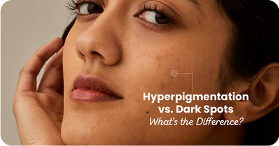 Hyperpigmentation vs. Dark Spots: What’s the Difference?