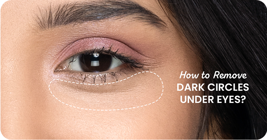 How to Remove Dark Circles Under Eyes Permanently?