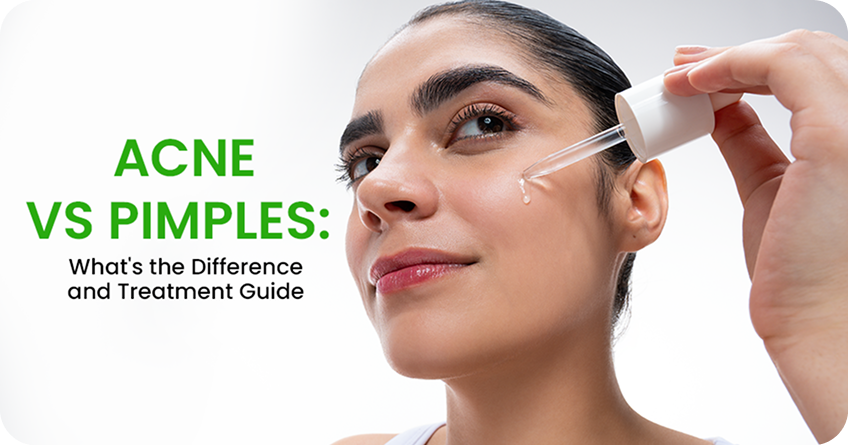 Acne vs Pimples: What's the Difference and Treatment Guide