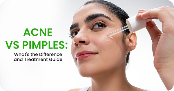 Acne vs Pimples: What's the Difference and Treatment Guide