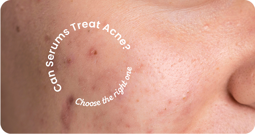 Can Serums Treat Acne? Choosing the Right One for Clear Skin
