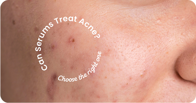 Can Serums Treat Acne? Choosing the Right One for Clear Skin