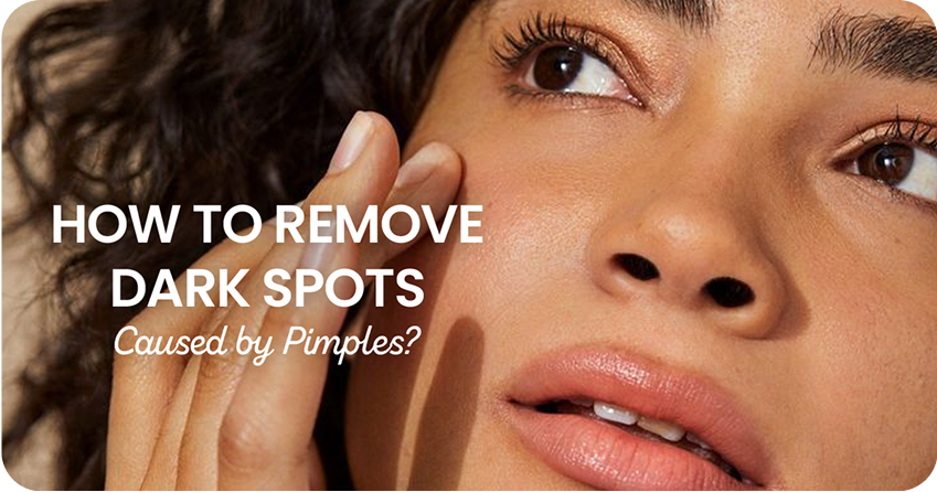 How to Remove Dark Spots Caused by Pimples?