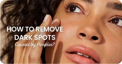 How to Remove Dark Spots Caused by Pimples?