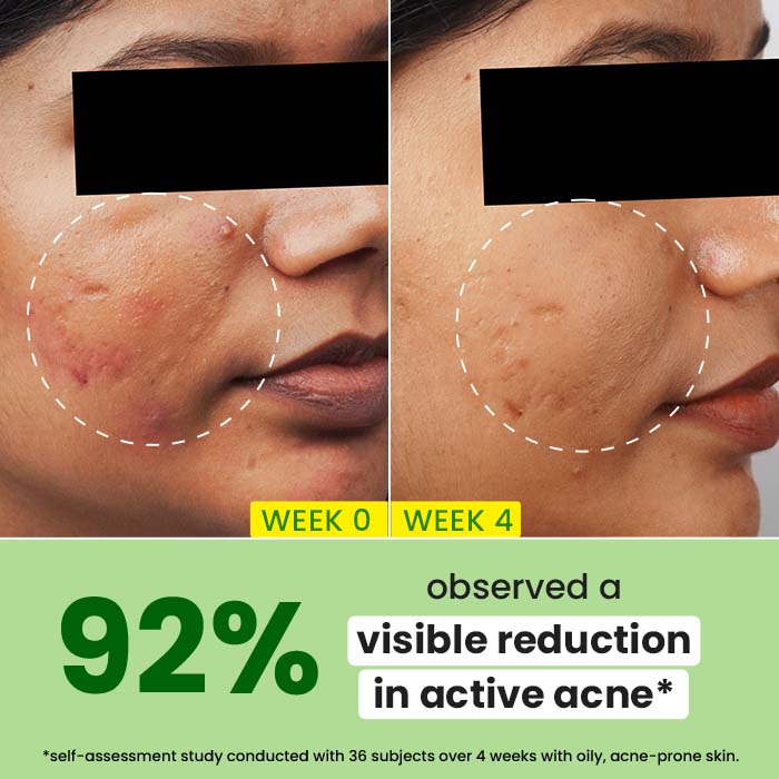 Cica + 2% Salicylic Acid Serum for Acne