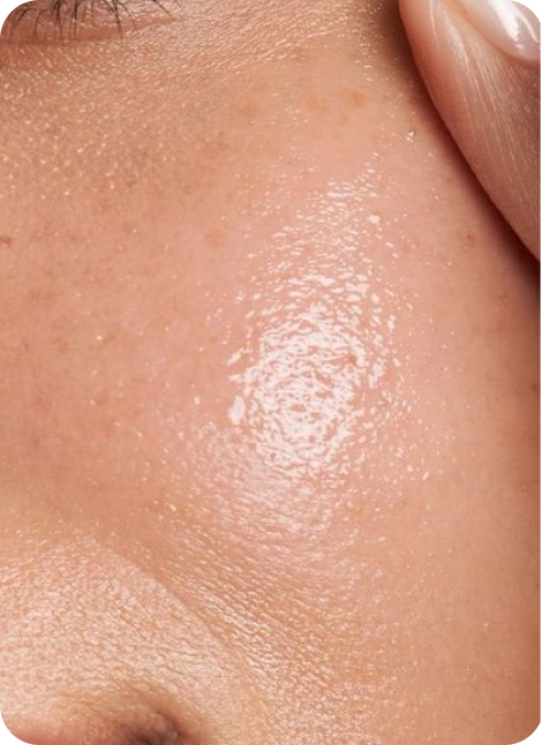 How to Deal with Skin Purging When Starting a New Serum