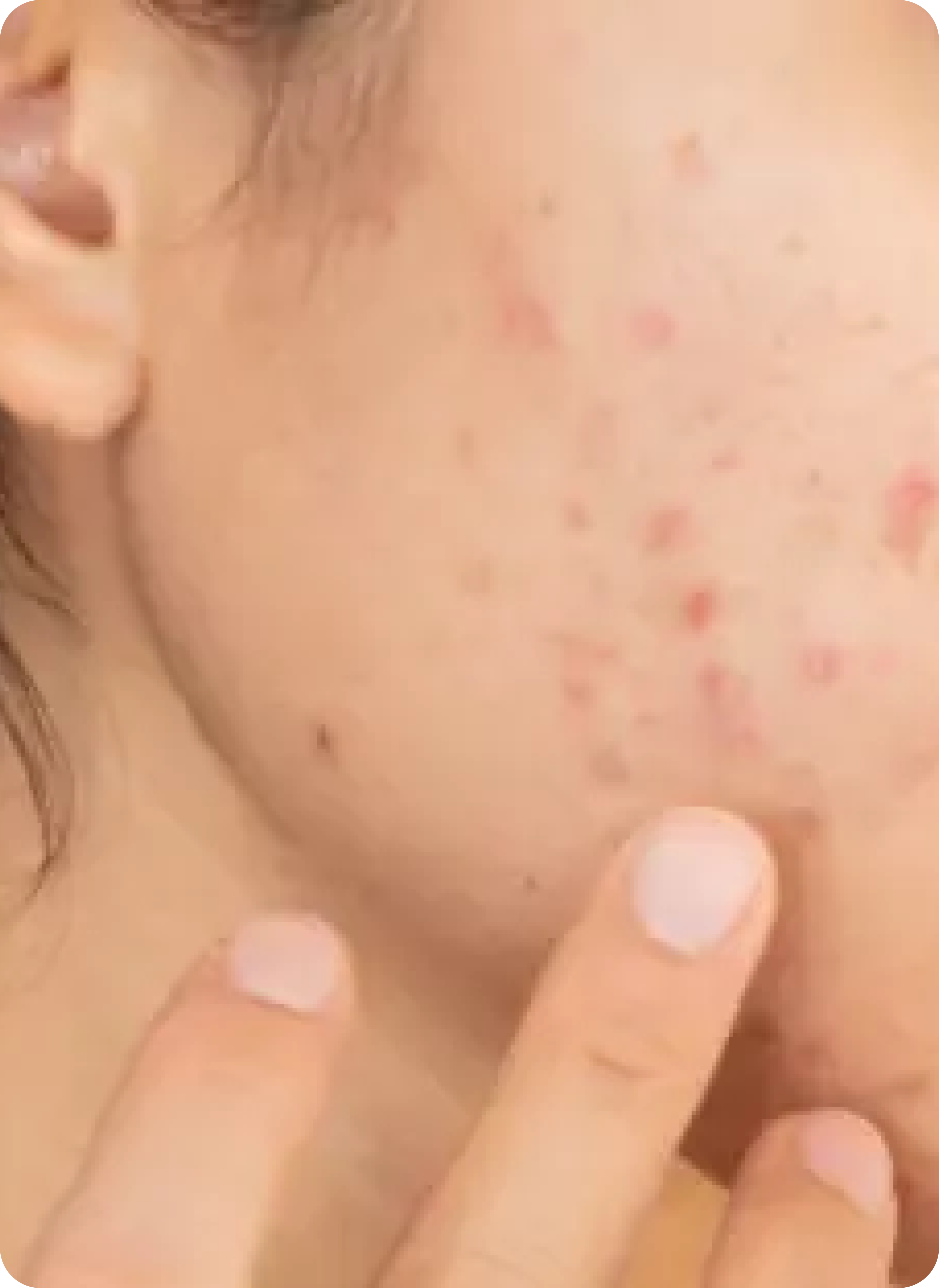 Best Skin Care Routine for Acne Scars (AM & PM)