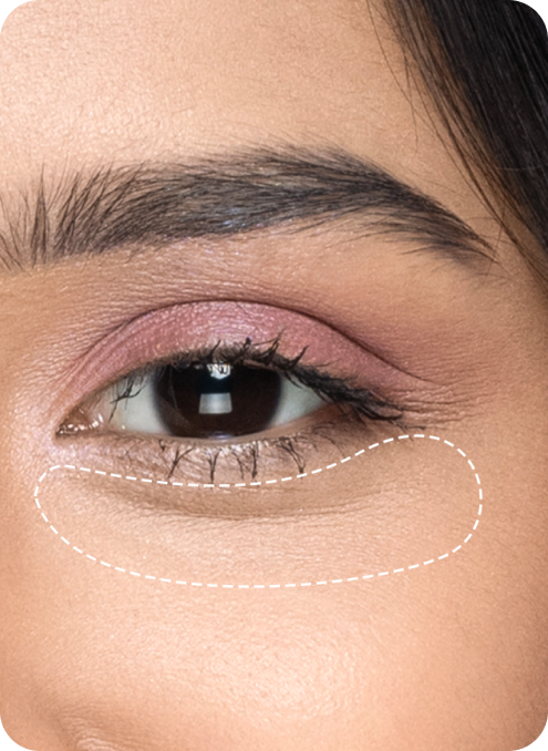 How to Remove Dark Circles Under Eyes Permanently?